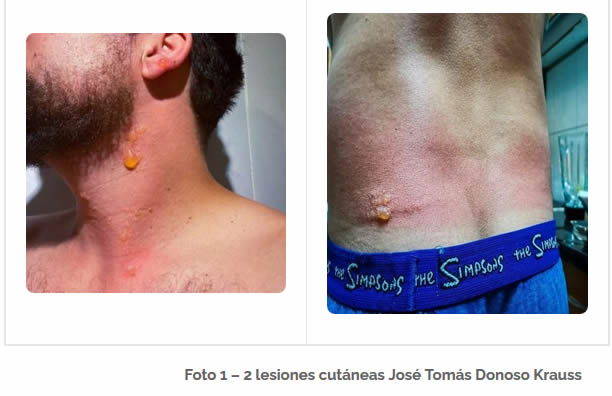 lesiones cutáneas José Tomás Donoso Krauss